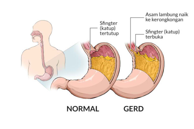 penyakit asam lambung