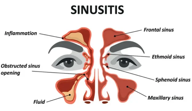 sinusitis adalah penyakit yang membuat pernafasan terganggu